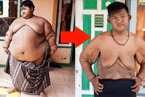 Cậu bé béo nhất thế giới giảm 216 kg thành công, trở lại cuộc sống bình thường