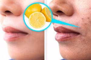 7 nguyên nhân khiến da mặt xuất hiện vết thâm và cách khắc phục