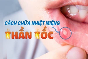 Mẹo đơn giản giảm sưng đau nhiệt miệng nhanh bất ngờ