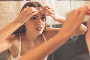 Những vị trí nổi mụn trên mặt tiết lộ tình trạng sức khỏe của bạn