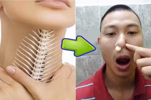 Mẹo chữa hóc xương cá chỉ trong "1 nốt nhạc"