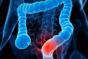 Cơ thể có 4 biểu hiện này, bạn nên đi nội soi để đề phòng ung thư trực tràng