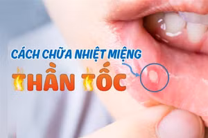 Mẹo đơn giản giảm sưng đau nhiệt miệng nhanh bất ngờ