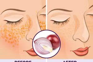 10 mẹo vặt giúp chữa nám da tại nhà hiệu quả