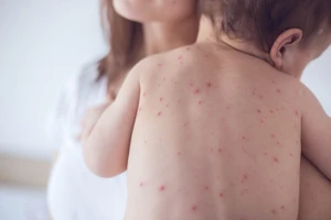 Bộ Y tế đề nghị rà soát đối tượng chưa tiêm vaccine Sởi