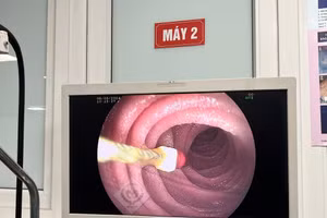 Bác sĩ nội soi cho thấy chiếc kim diệt tủy răng nằm ở tá tràng của bệnh nhi. (Ảnh: BVCC)