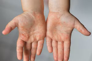 Gia tăng ca mắc bệnh tay chân miệng tại TPHCM