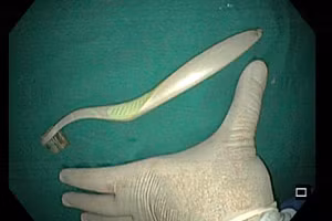 Chiếc bàn chải có độ dài hơn 20cm được lấy ra khỏi dạ dày bệnh nhân. (Ảnh: Bệnh viện cung cấp)