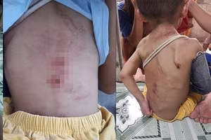 Vết thương trên người bé trai.