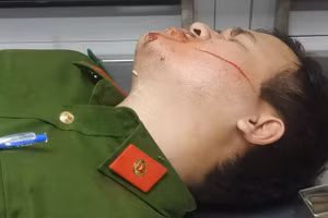 Vết thương trên mặt Thượng úy Danh. Ảnh: Công an.