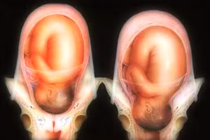 Nữ sinh lớp 8 mang thai đôi. Ảnh minh họa.