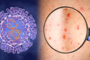 Cà Mau ra văn bản hỏa tốc tăng cường phòng, chống bệnh đậu mùa khỉ