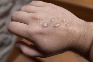 Bệnh đậu mùa khỉ.