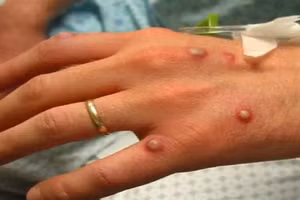 Bệnh đậu mùa khỉ.