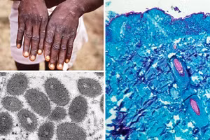 Bệnh đậu mùa khỉ.