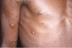 Da có biểu hiện tổn thương do bệnh đậu khỉ đang hoạt động.