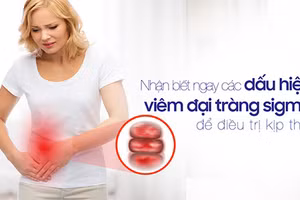 Viêm đại tràng sigma là bệnh khá thường gặp