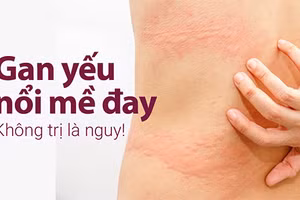 Gan yếu nổi mề đay có thể gây ảnh hưởng lớn đến sức khỏe và đời sống