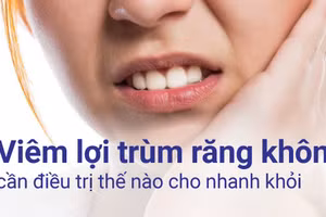 Viêm lợi trùm răng khôn gây đau nhức và ảnh hưởng đến sinh hoạt hàng ngày