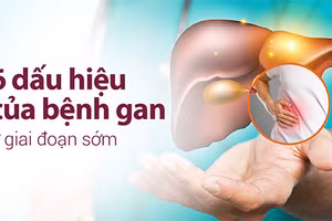 Dấu hiệu của bệnh gan không khó để nhận biết