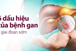 Dấu hiệu của bệnh gan không khó để nhận biết