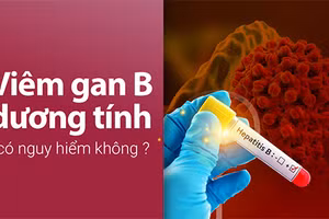 Viêm gan B dương tính có thể làm tăng nguy cơ xơ gan, ung thư gan