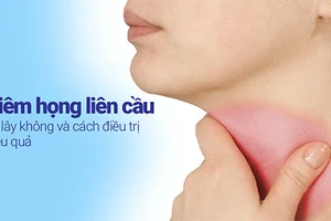 Viêm họng liên cầu rất dễ lây lan