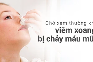 Viêm xoang bị chảy máu mũi cần hết sức thận trọng