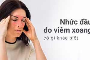 Nhức đầu do viêm xoang thường bị nhầm với đau nửa đầu