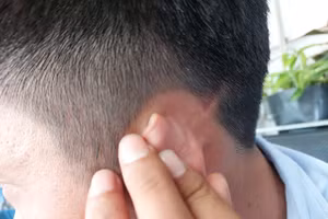 Vết thương trên đầu anh Nghĩa đã lành.