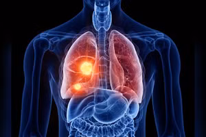 Nghiên cứu thuốc dạng uống hàng ngày cho phép giảm nguy cơ tử vong vì ung thư phổi tới 51%. 