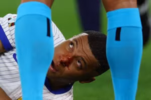 Chùm ảnh: Mbappe gãy xương mũi, phải đeo mặt nạ ở EURO 2024 