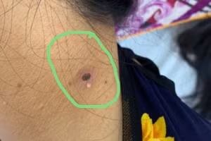 Vết loét của bệnh nhân bị mò đốt. Ảnh: BSCC.