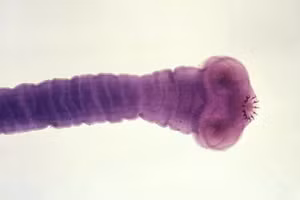 Ấu trùng sán dây làm tổ trong não người phụ nữ ở Australia