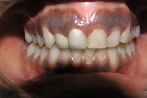 Đường viền Burton quanh chân răng của bệnh nhân nhiễm độc chì. Ảnh minh họa.