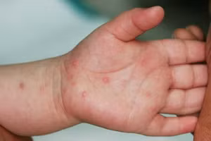 Cha mẹ không nên tự ý bôi thuốc lên da khi trẻ mắc tay chân miệng. Ảnh minh họa.