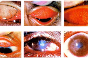 Hình ảnh người bị đau mắt hột. Ảnh: Bác sĩ cung cấp.