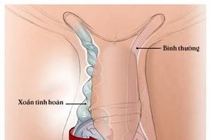 Căn bệnh khiến bé trai 11 tuổi mất tinh hoàn