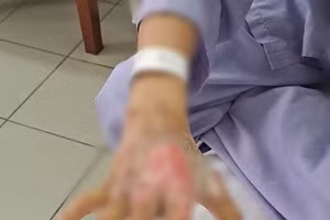 Trẻ nhập viện trong tình trạng bỏng nặng 2 cẳng tay, Ảnh: BVCC