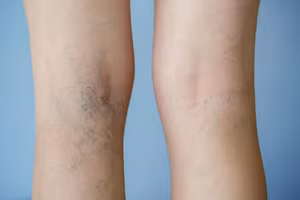 Người đàn ông nguy cơ tàn phế do hút thuốc nhiều năm