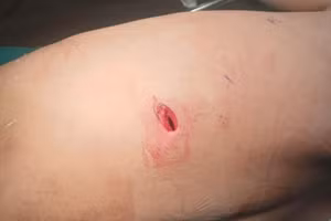 Vết rách khiến trẻ nhỏ nguy kịch vì rách phổi. Ảnh: BVCC