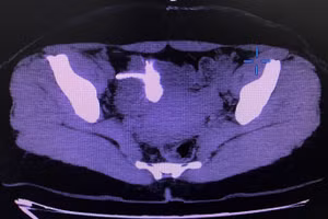 Vòng tránh thai đi lạc vào bàng quang người phụ nữ 