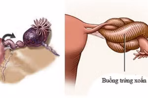 Ảnh minh họa xoắn buồng trứng