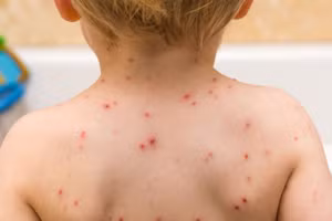 Ca mắc thủy đậu tại Hà Nội tăng cao