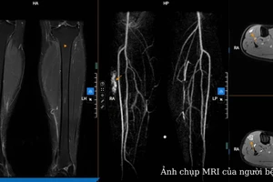 Dựa vào các kết quả, bác sĩ kết luận đây là khối dị dạng mạch máu vị trí 1/3 trên cơ chày trước cẳng chân bên phải. Ảnh: BVCC.