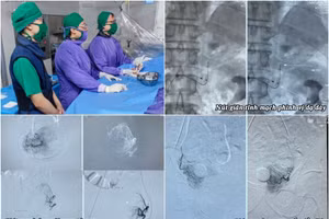 Kíp bác sĩ khoa Chẩn đoán hình ảnh thực hiện 3 ca can thiệp trong một ngày. Ảnh: BVCC.