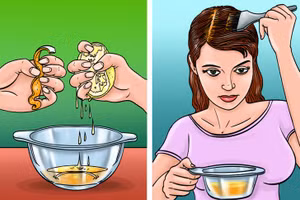 Mẹo ngăn ngừa gàu vô cùng hữu ích