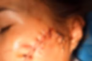 Chị L. bị Nguyễn Văn Thắng dùng dao chém nhiều nhát vào mặt.