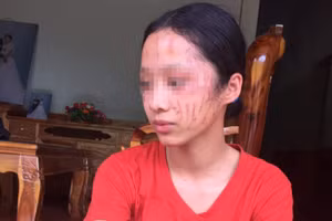 Em Lưu Thị H. (Trường PT DTBT THCS Thạch Ngàn, huyện Con Cuông, Nghệ An) bị nhiều vết thương trên mặt.