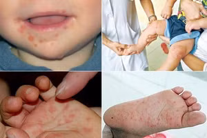 Hiện ngành y tế TPHCM ghi nhận số mắc bệnh tay chân miệng vẫn tăng nhanh. (Ảnh:HCDC)